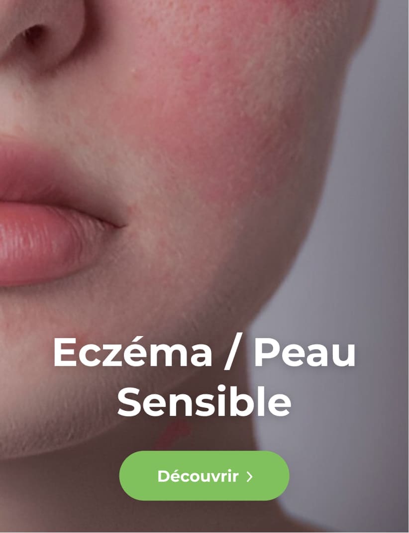 Peau sensible